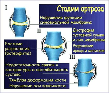 лечение на заболяване на остеоартрит на коляното